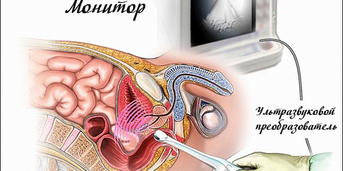 УЗИ простаты (ТРУЗИ)