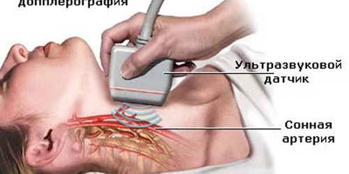 Дуплексное (допплеровское)  исследование брахицефальных сосудов (шеи)