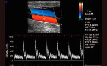 Триплексное УЗИ