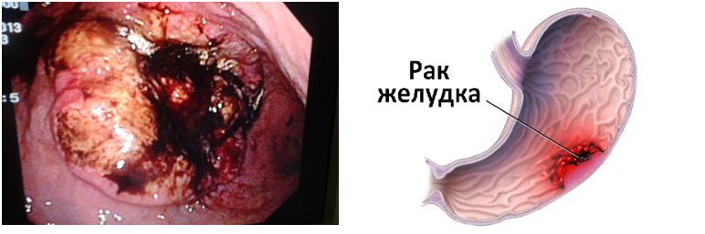 Рак желудка, схема