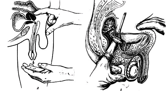 Массаж простсты- получение секрета простаты