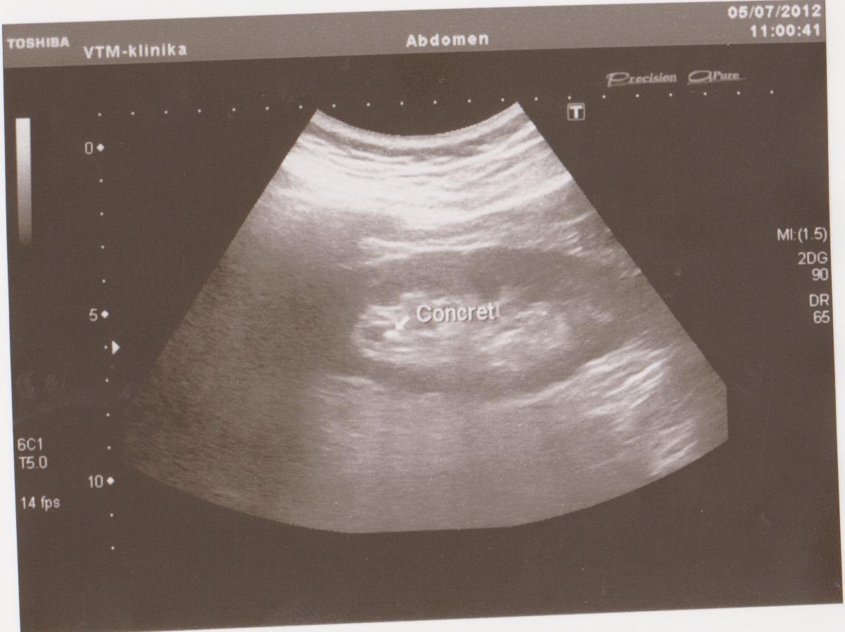 нормальная почка на УЗИ