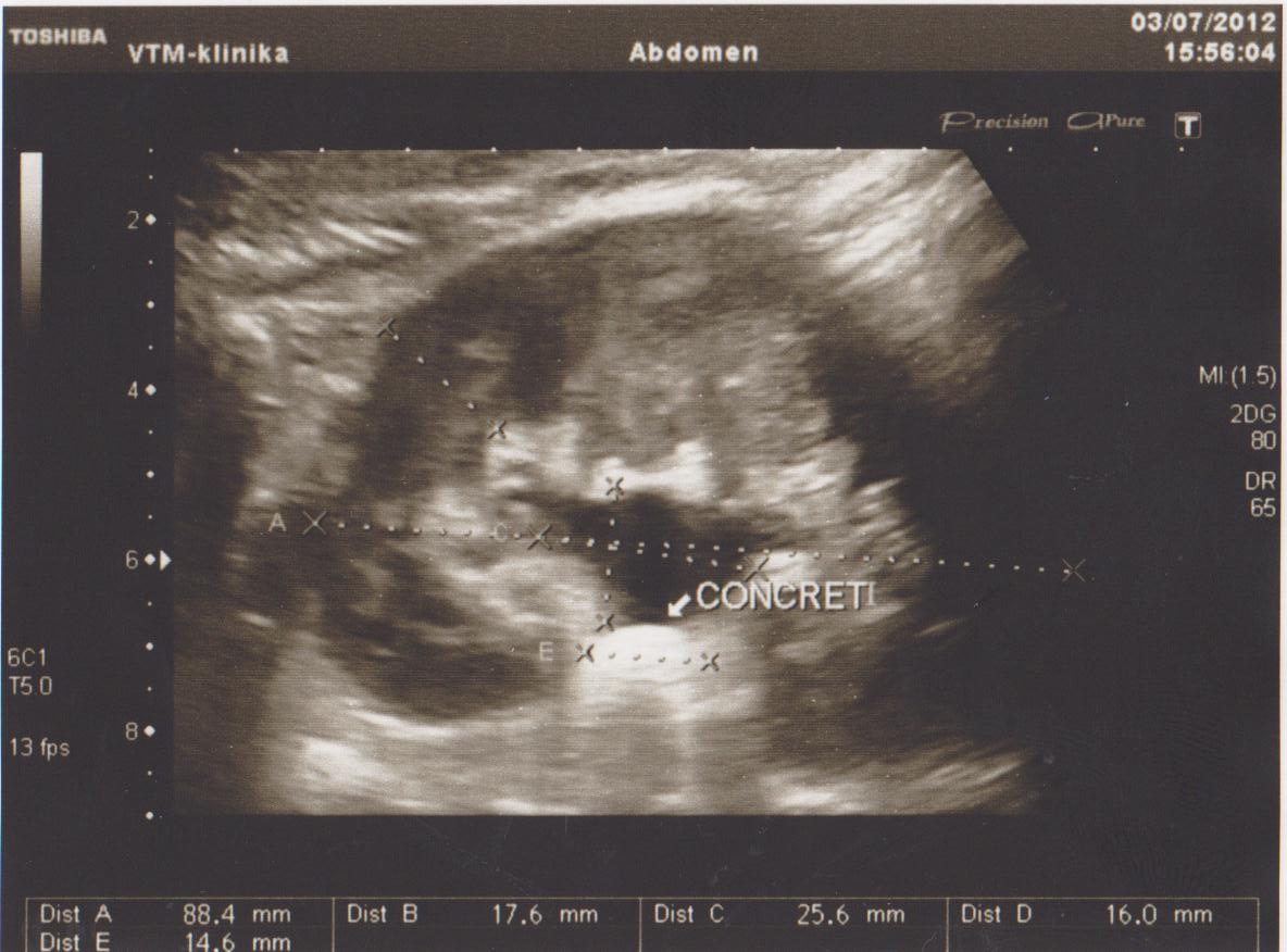 камень лоханки и пиелоэктазия