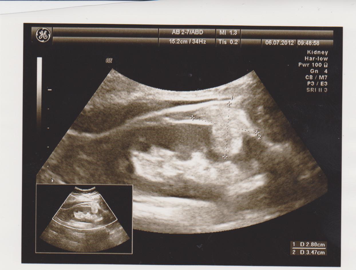 опухоль почки