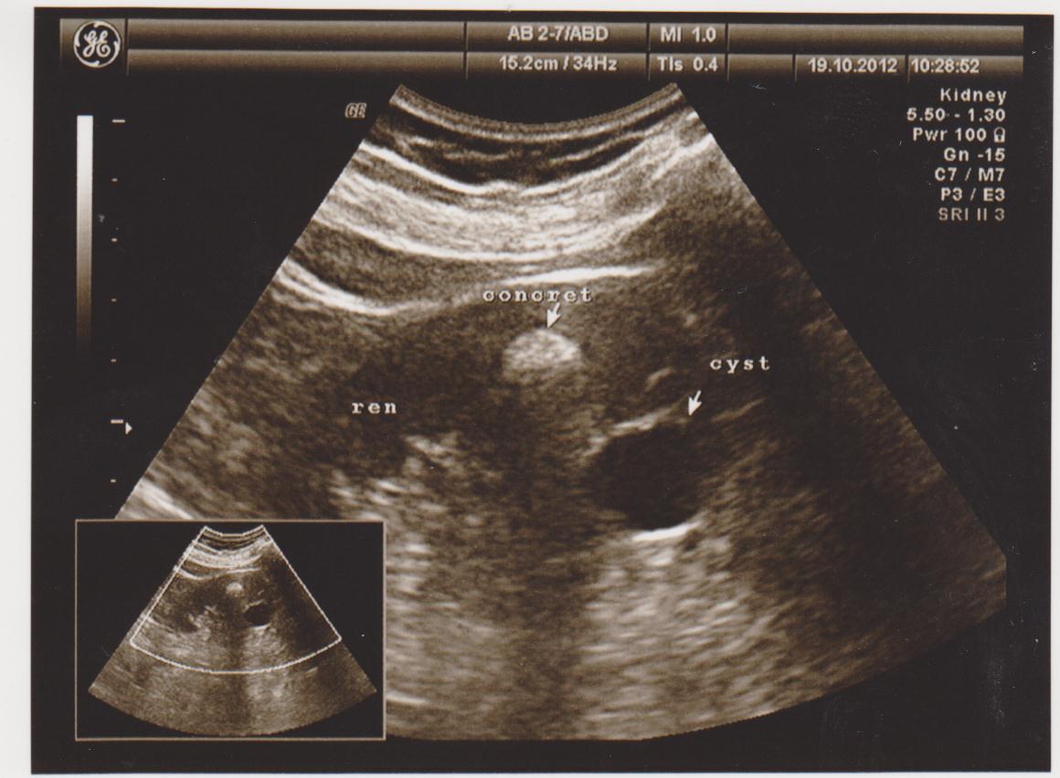Киста почки и камень почки