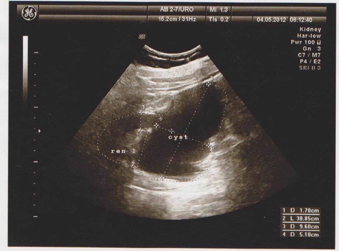 Крупная киста почки