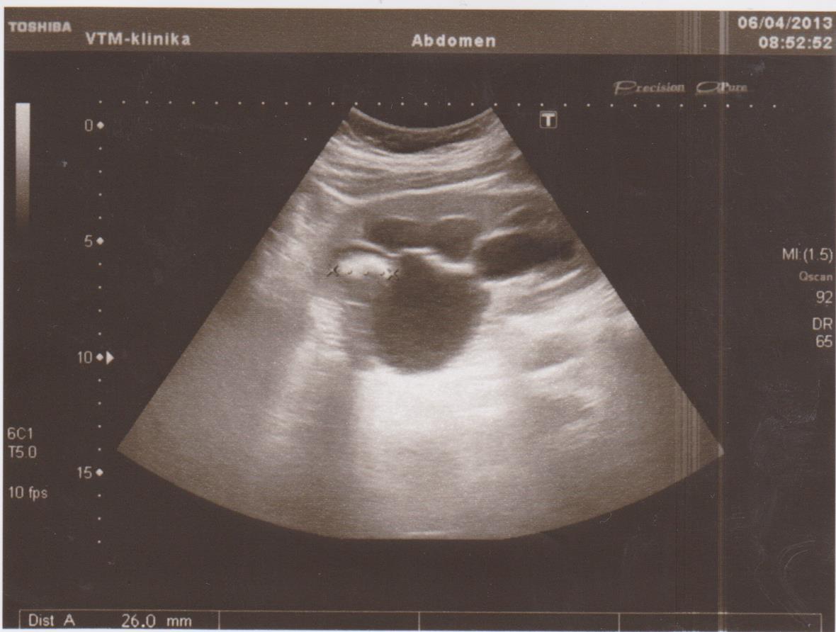 Гидронерфоз и камень почки